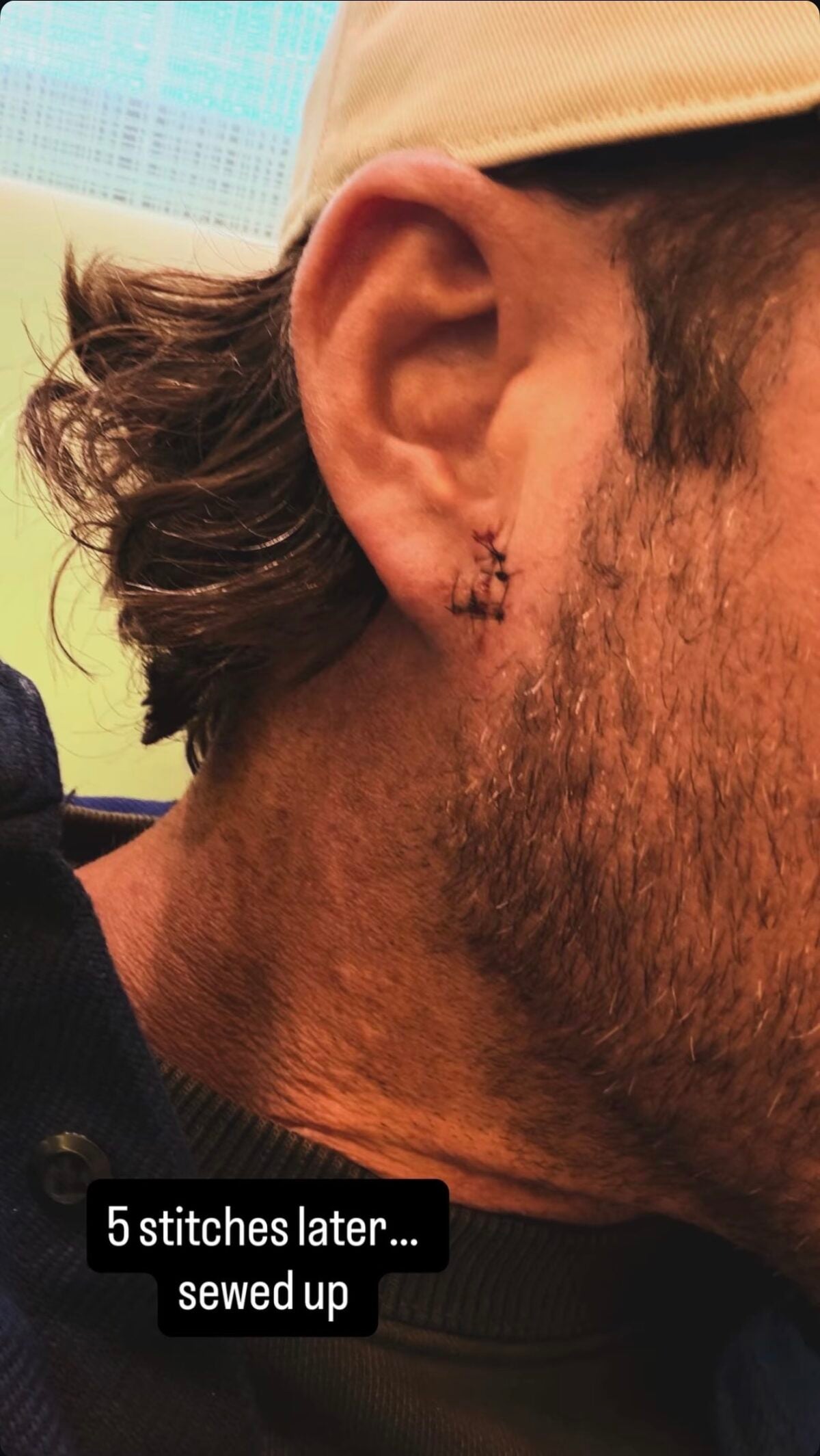 stitches on riley green's ear 