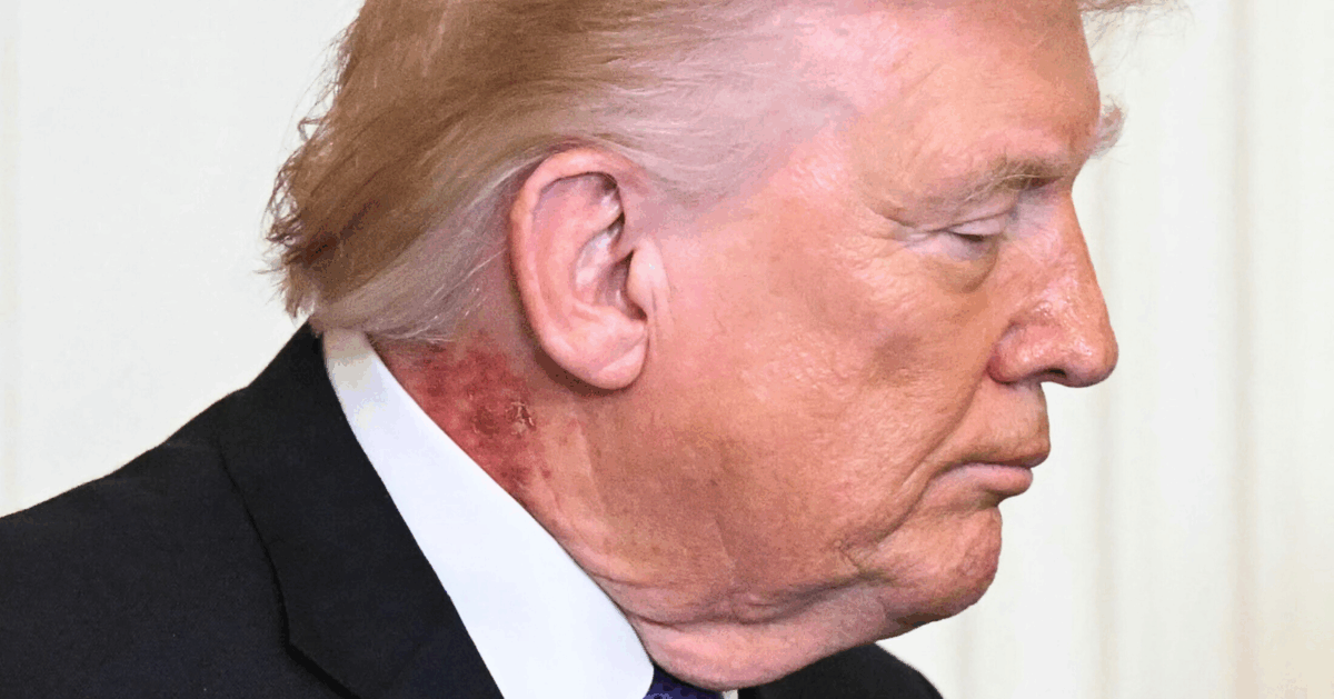 An area of irritated red skin was spotted on President Trump's neck on March 2, and was addressed by the president's physician.