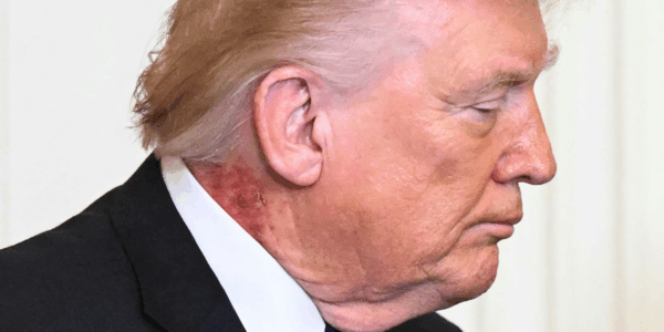 An area of irritated red skin was spotted on President Trump's neck on March 2, and was addressed by the president's physician.